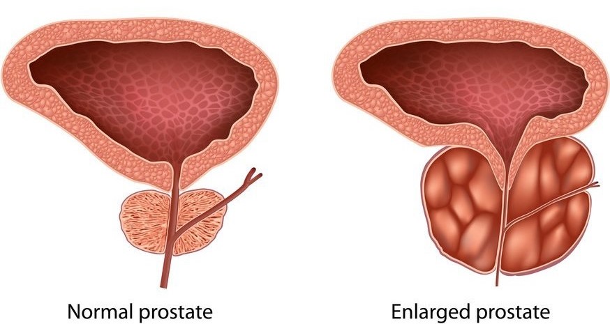 Chronic-Prostatitis